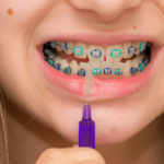 Aftercare for Braces and Invisalign
