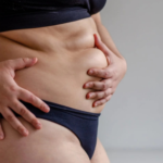 What Affects the Cost of a Tummy Tuck? 7 Key Factors You Should Know